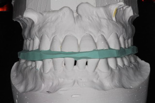 Figure 2. Showing putty within the teeth.