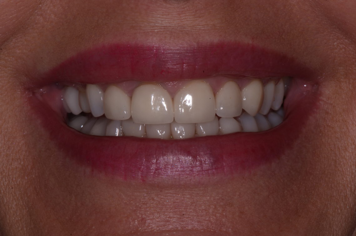 Figure 1. Before full smile