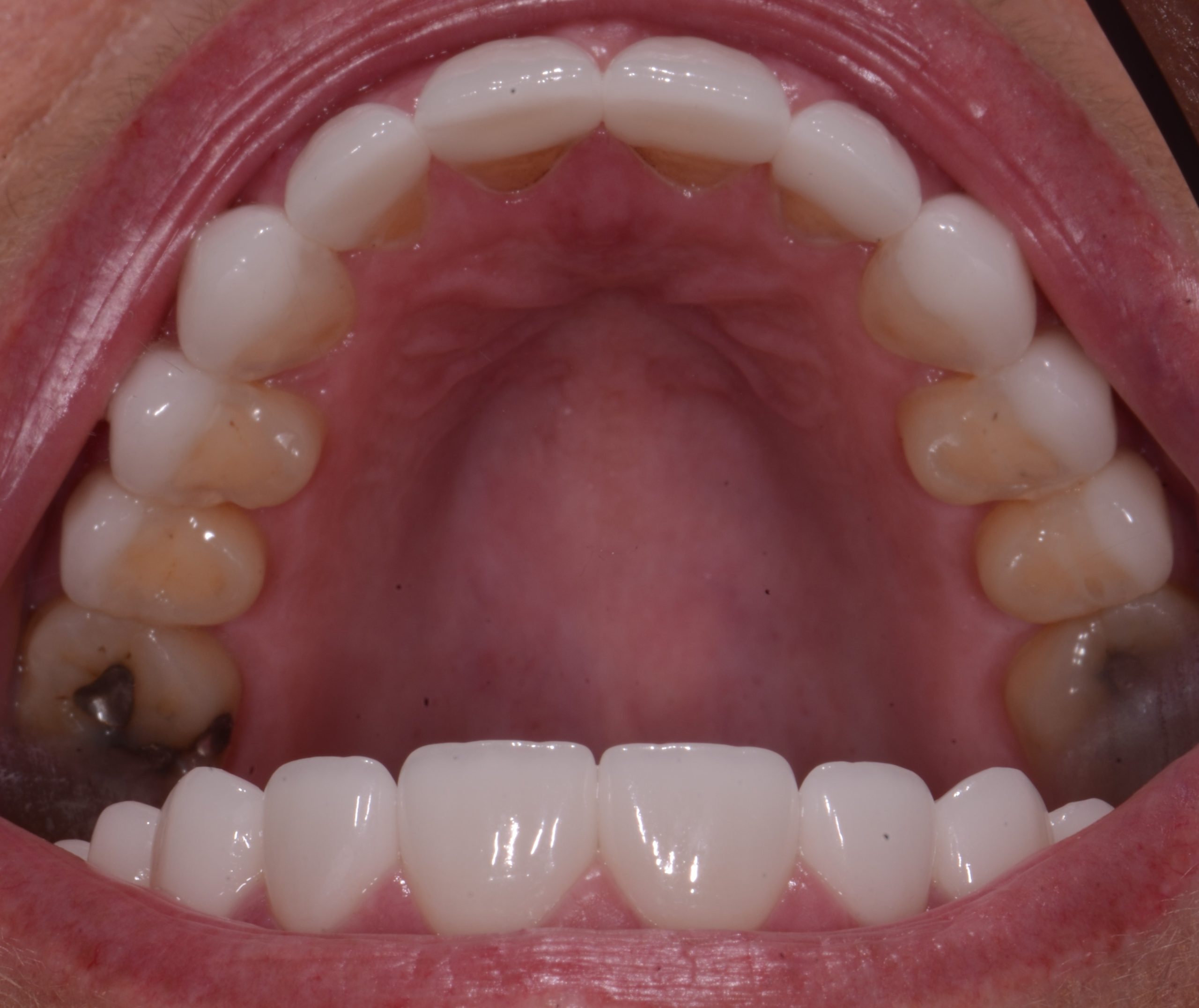 After Occlusal