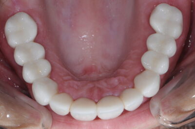 Occlusal after